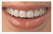 What are the disadvantages of Ceramic Braces?