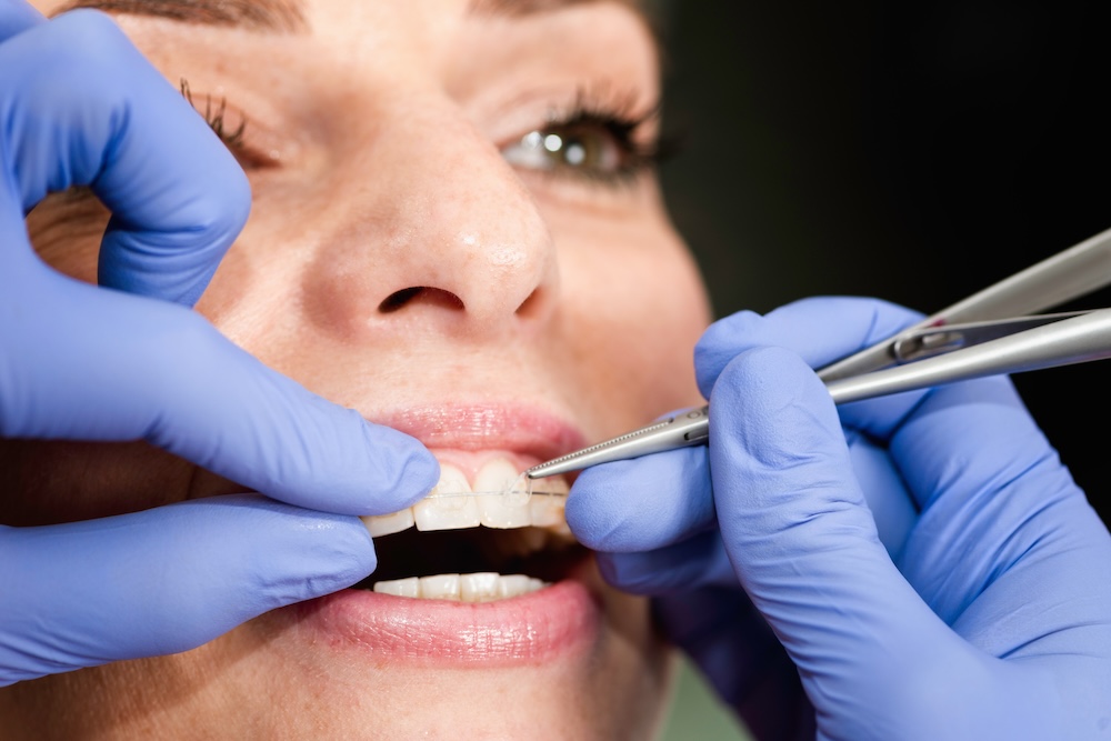 Close up of woman getting ceramic braces put on by a dental professional