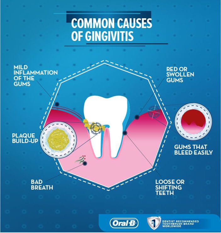 Common causes of gingivitis