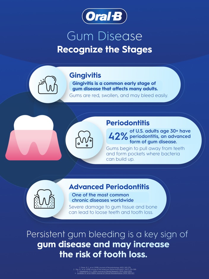Stages of gum disease beginning with Gingivitis, Periodontitis, and Advanced Periodontitis, and a fact about gum bleeding increasing tooth loss risk