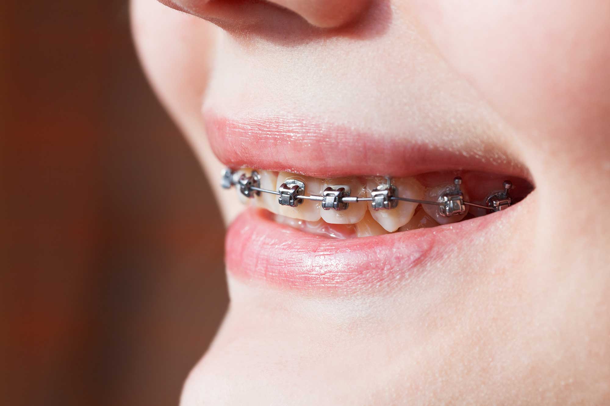Close-up of kid smiling and showing their braces