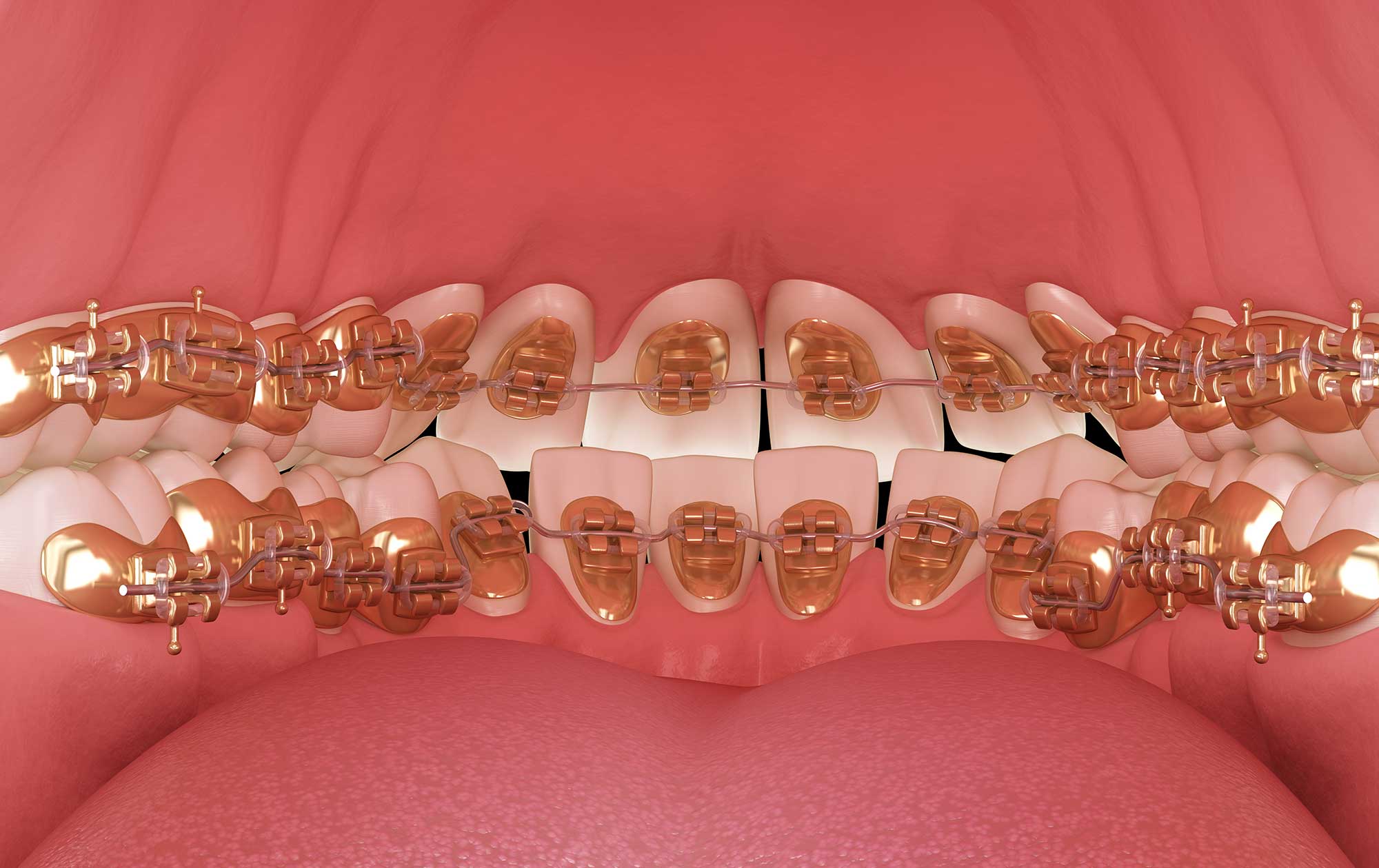 Close-up of lingual braces installed on the inside of teeth