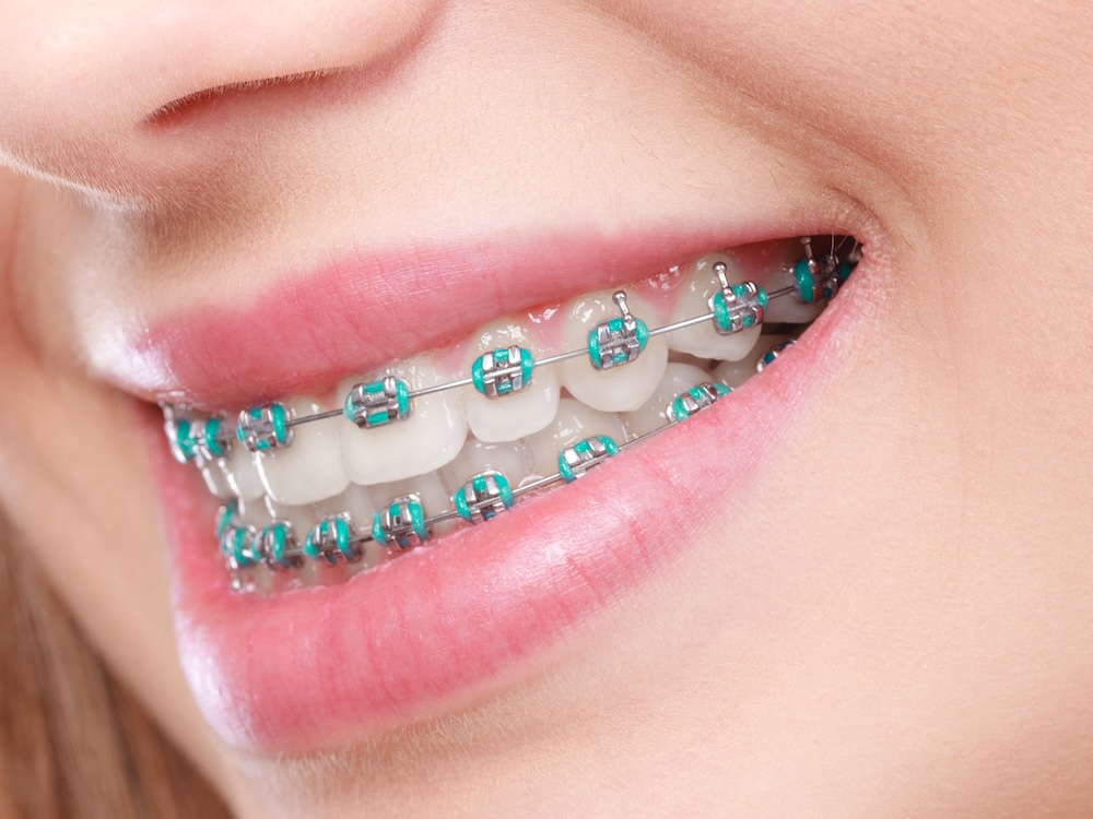 How to Pick the Best Colors for Your Braces