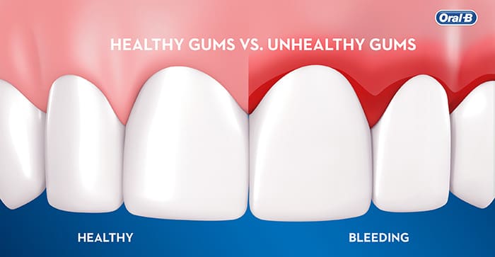bleeding gums concept