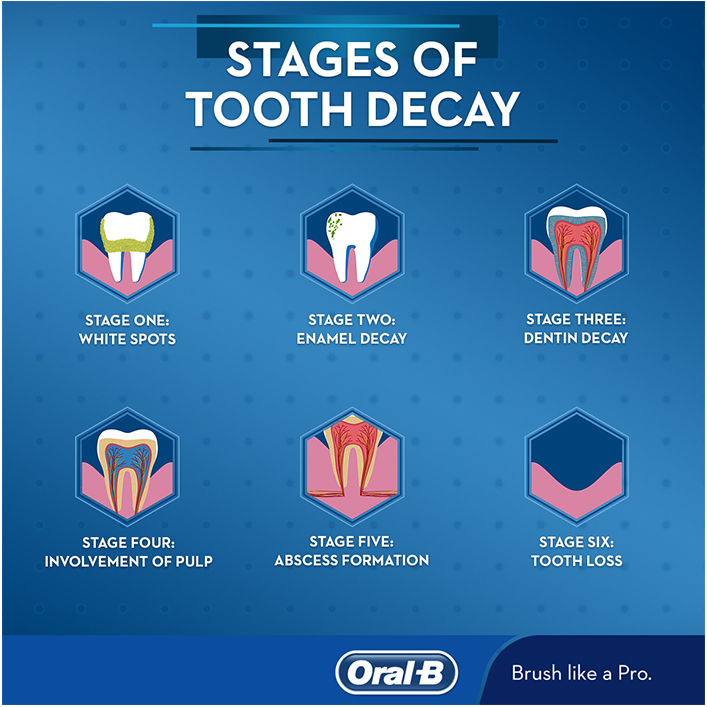 Tooth Decay Stages