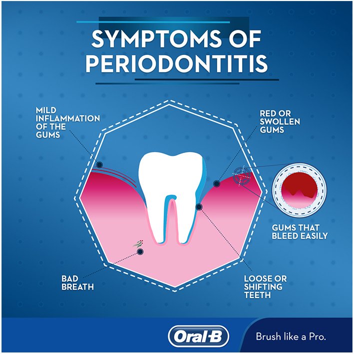 symptoms-of-periodontis