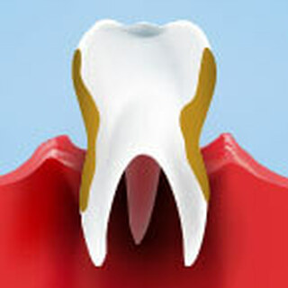 Periodontitis