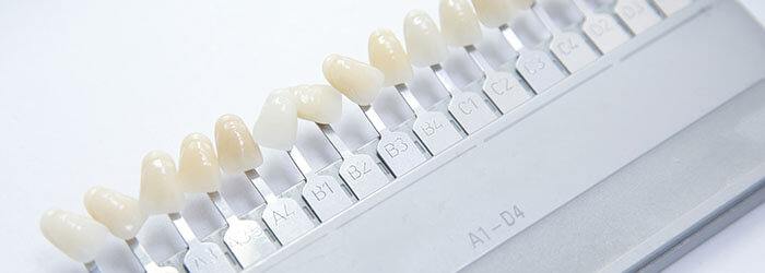 Dental Veneers