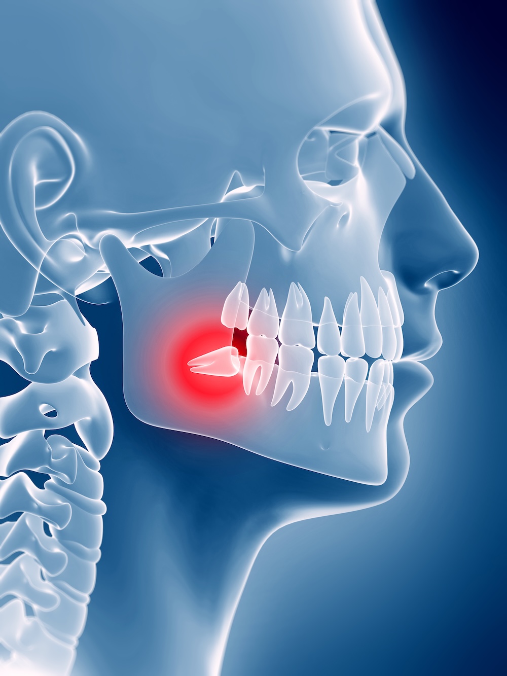 Stylized x-ray showing a person's side profile with a painful wisdom tooth growing in