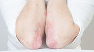 Why Does Eczema Flare Up? Unveiling the Three Most Common Triggers