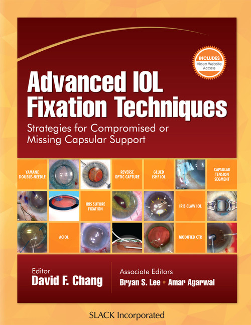 Advanced IOL Fixation Techniques: Strategies for Compromised or Missing Capsular Support Advanced IOL Fixation Techniques: Strategies for Compromised or Missing Capsular Support