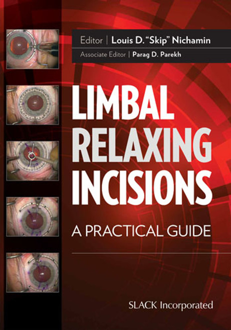 Limbal Relaxing Incisions: A Practical Guide