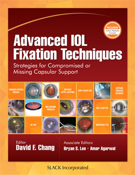 Advanced IOL Fixation Techniques: Strategies for Compromised or Missing Capsular Support