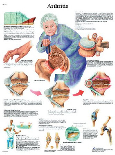 CHRT ANATOM ARTHRITIS LAM D/S EA FABENT 12-4605L Each/1