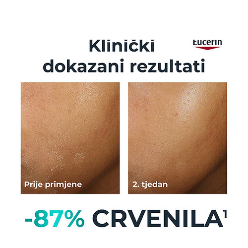 Eucerin DermoPure Clinical umirujuća krema tijekom propisane terapije liječenja akni, 50 ml