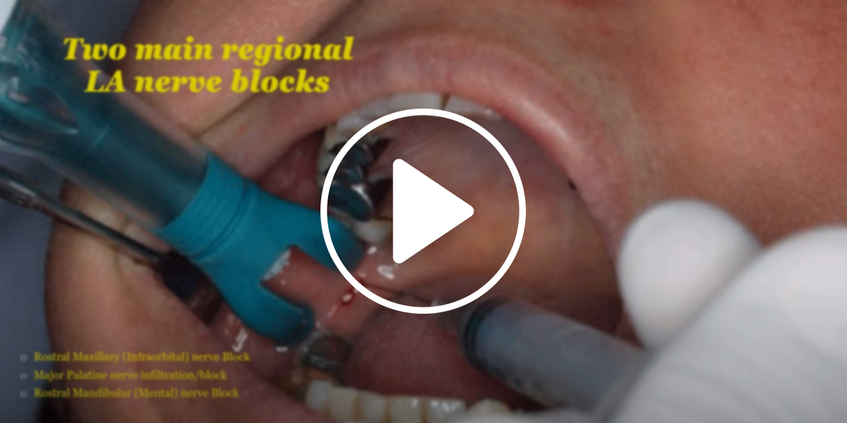 A video on Local Anaesthetic Techniques for Dentistry