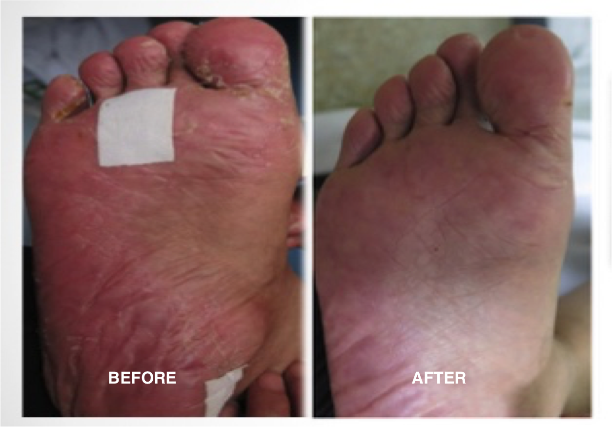 Hand to Heal(TM) Cream Significantly Relieves Symptoms of HandFoot