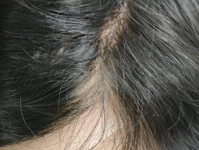 HD105 men hair system

