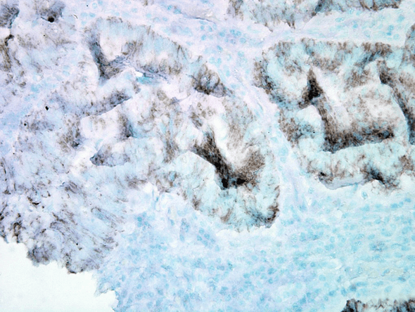 Immunohistochemistry analysis using Mouse Anti-Hsp60 Monoclonal Antibody, Clone LK-2 (STMA00008). Tissue: colon carcinoma. Species: Human. Fixation: Formalin. Primary Antibody: Mouse Anti-Hsp60 Monoclonal Antibody (STMA00008) at 1:100000 for 12 hours at 4°C. Secondary Antibody: Biotin Goat Anti-Mouse at 1:2000 for 1 hour at RT. Counterstain: Mayer Hematoxylin (purple/blue) nuclear stain at 200 µl for 2 minutes at RT.