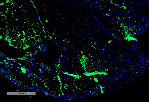 Immunohistochemistry analysis using Mouse Anti-Parvalbumin Monoclonal Antibody, Clone C12 (STMA00205). Tissue: Thyroid Cancer. Species: Human. Primary Antibody: Mouse Anti-Parvalbumin Monoclonal Antibody (STMA00205) at 1:100 for Overnight at 4C, then 30 min at 37C. Secondary Antibody: Goat Anti-Mouse IgG (H+L): FITC for 45 min at 37C. Counterstain: DAPI for 3 min at RT. Magnification: 5X.