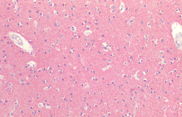 Immunohistochemistry analysis using Rabbit Anti-Tau Polyclonal Antibody (STPA00088). Tissue: Brain Cortex. Species: Human. Fixation: Formalin fixed paraffin-embedded. Primary Antibody: Rabbit Anti-Tau Polyclonal Antibody (STPA00088).