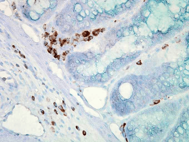 Immunohistochemistry analysis using Mouse Anti-Hsp70 Monoclonal Antibody, Clone C92F3A-5 (STMA00001). Tissue: colon carcinoma. Species: Mouse. Fixation: Formalin. Primary Antibody: Mouse Anti-Hsp70 Monoclonal Antibody (STMA00001) at 1:10000 for 12 hours at 4°C. Secondary Antibody: Biotin Goat Anti-Mouse at 1:2000 for 1 hour at RT. Counterstain: Mayer Hematoxylin (purple/blue) nuclear stain at 200 µl for 2 minutes at RT.