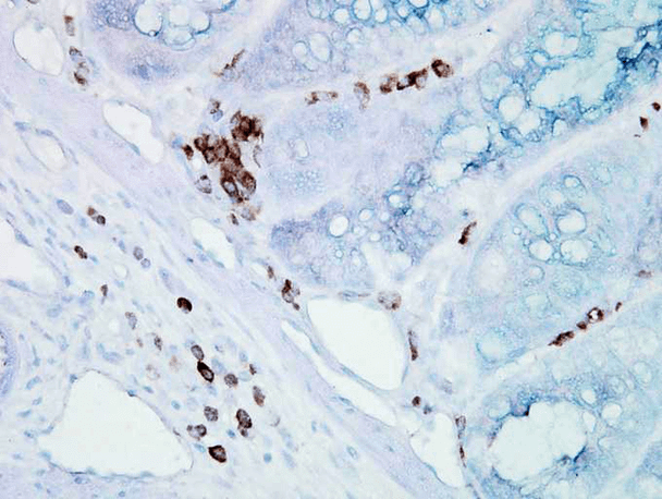 Immunohistochemistry analysis using Mouse Anti-Hsp70 Monoclonal Antibody, Clone BB70 (STMA00004). Tissue: inflamed colon. Species: Mouse. Fixation: Formalin. Primary Antibody: Mouse Anti-Hsp70 Monoclonal Antibody (STMA00004) at 1:10000 for 12 hours at 4°C. Secondary Antibody: Biotin Goat Anti-Mouse at 1:2000 for 1 hour at RT. Counterstain: Mayer Hematoxylin (purple/blue) nuclear stain at 200 µl for 2 minutes at RT.