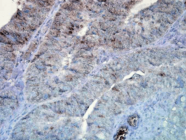 Immunohistochemistry analysis using Mouse Anti-Hsp90 Monoclonal Antibody, Clone D7alpha (STMA00020). Tissue: colon carcinoma. Species: Human. Fixation: Formalin. Primary Antibody: Mouse Anti-Hsp90 Monoclonal Antibody (STMA00020) at 1:100000 for 12 hours at 4°C. Secondary Antibody: Biotin Goat Anti-Mouse at 1:2000 for 1 hour at RT. Counterstain: Mayer Hematoxylin (purple/blue) nuclear stain at 200 µl for 2 minutes at RT. Magnification: 40x.