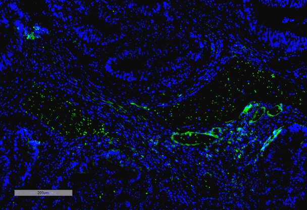Immunohistochemistry analysis using Mouse Anti-VPS35 Monoclonal Antibody, Clone 10A8 (STMA00211). Tissue: Thyroid Cancer. Species: Human. Primary Antibody: Mouse Anti-VPS35 Monoclonal Antibody (STMA00211) at 1:100 for Overnight at 4C, then 30 min at 37C. Secondary Antibody: Goat Anti-Mouse IgG (H+L): FITC for 45 min at 37C. Counterstain: DAPI for 3 min at RT. Magnification: 10X.
