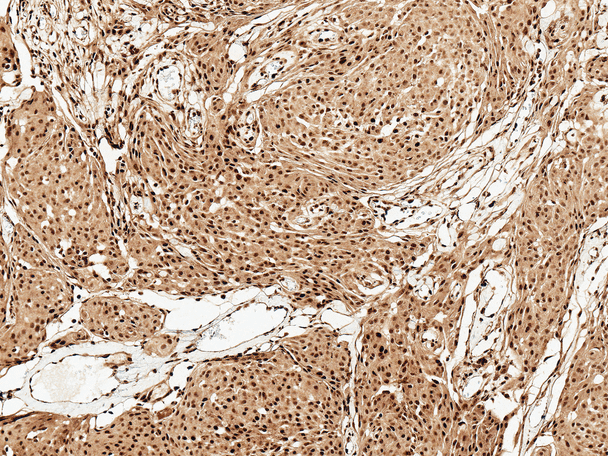 Immunohistochemistry analysis using Rabbit Anti-FUNDC1 Polyclonal Antibody (STPA00062). Tissue: Brain. Species: Human. Fixation: Formalin Fixed Paraffin-Embedded. Primary Antibody: Rabbit Anti-FUNDC1 Polyclonal Antibody (STPA00062) at 1:50 for 30 min at RT. Counterstain: Hematoxylin. Magnification: 10X. HRP-DAB Detection.