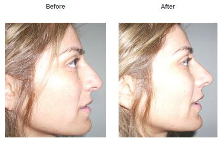 How to Lift Your Nose Tip Naturally Without Surgery