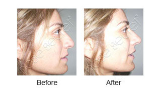 NoseSecret® 6-Pair Bundle Pack | Save 25% + Free Shipping