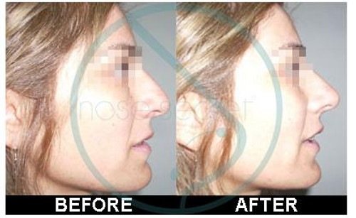 NoseSecret NoseSecret Kit S-M-L - SALE 30percent Off reflected at check out