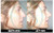 Before and after transformation with NoseSecret® M, L, XL kit – instant nose lift for hooked bridge noses Before and after transformation with NoseSecret® M, L, XL kit – instant nose lift for hooked bridge noses