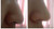 NOse visibly slimmer after using teh nasal splintsx NoseSecret