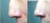 Nose hump corrected with the NoseSecret® nose corrector