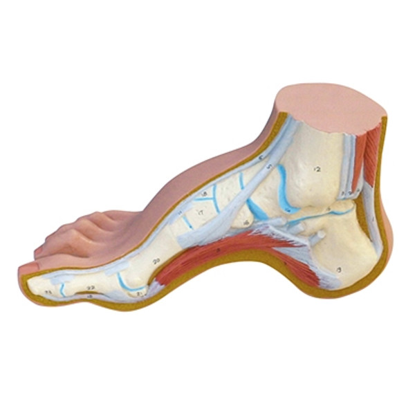 Anatomical Model: Hollow Foot (Pes Cavus)