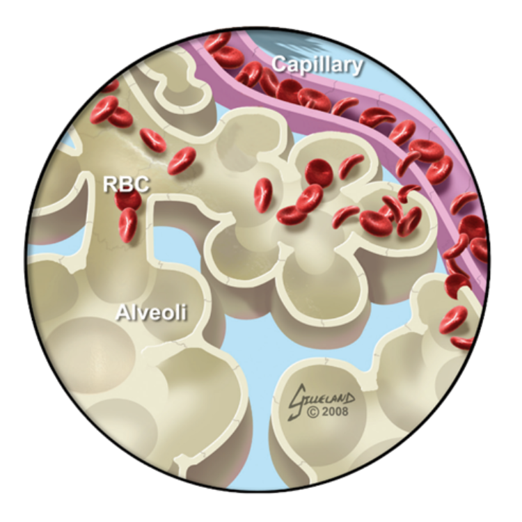 Fragile Pulmonary Capillary Membrane