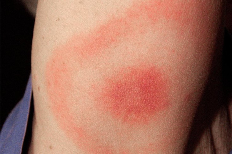 Lyme Disease
