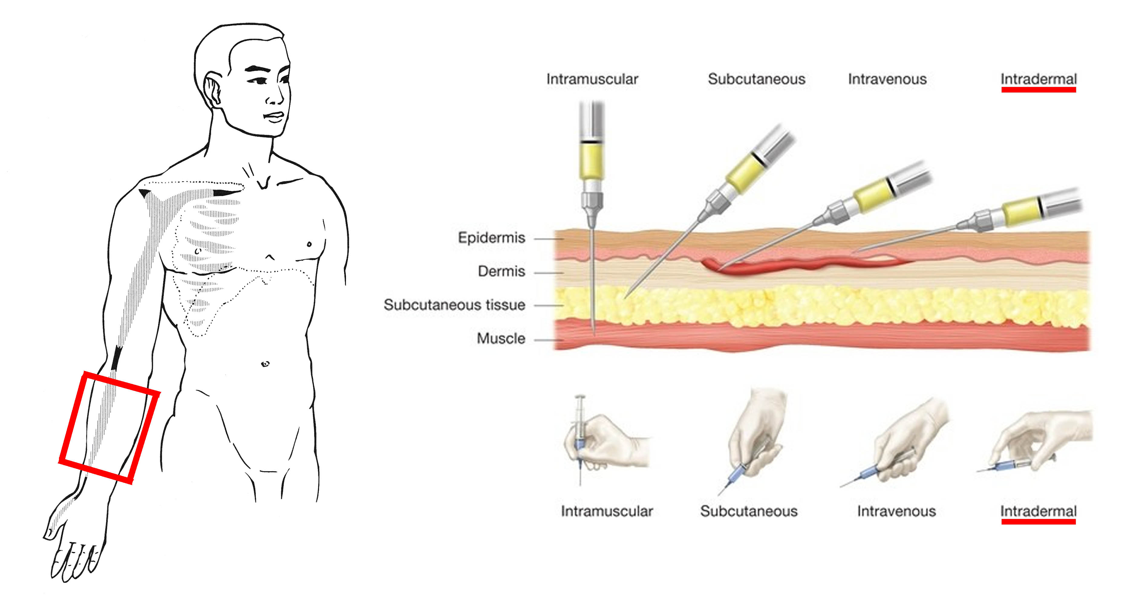 interdermal-injection.jpg