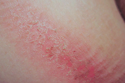 What Can I Put On Chafed Skin?