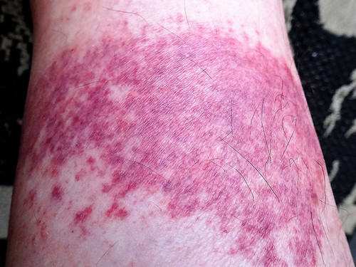 How Long Does A Chafing Rash Last?