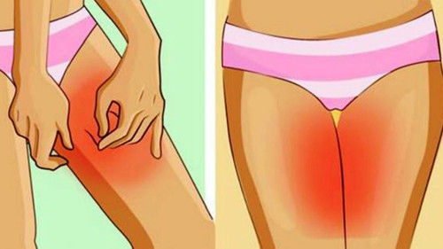 How to Treat Chafing in the Female Groin Area