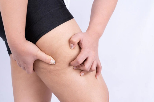 Home Remedies for Chafing