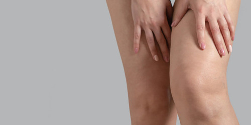 Chafed Skin: Causes, Treatments, and How to Prevent It for Good