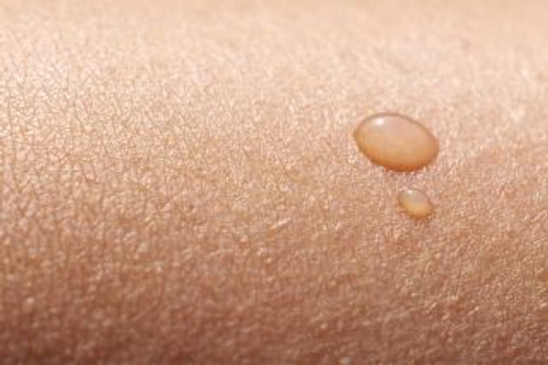 6 Home Remedies to Soothe Chafed Skin - No More Chafe - Thigh Guards