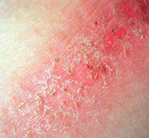 Chafing rashes occur due to friction on the skin and skin appear red and  inflamed, with crusting, swelling, or bleeding in severe cases.