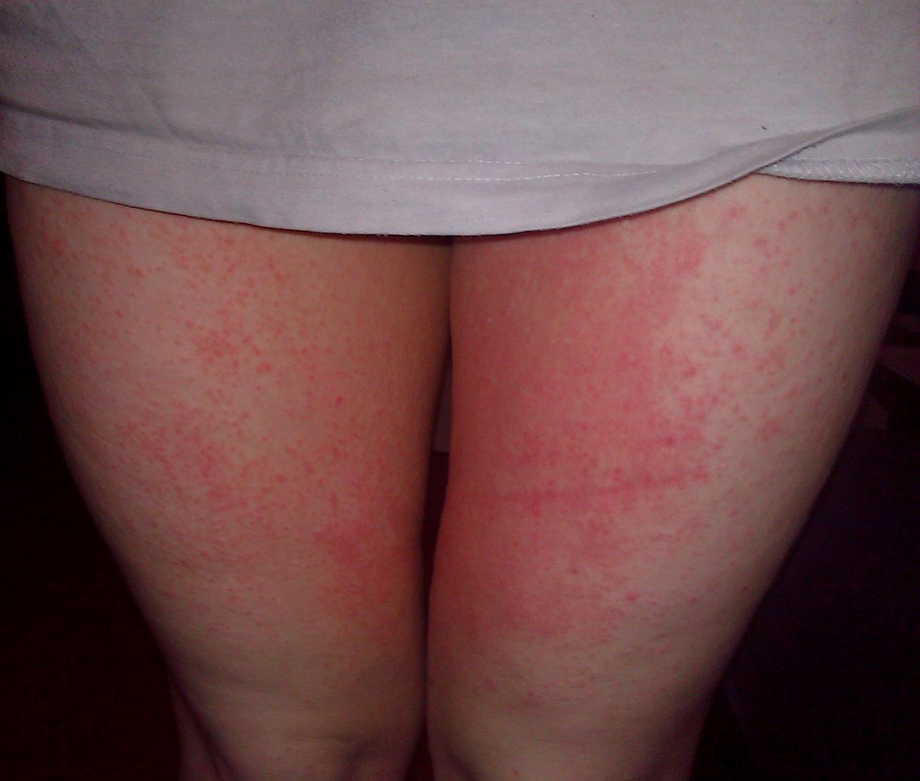 heat rash legs