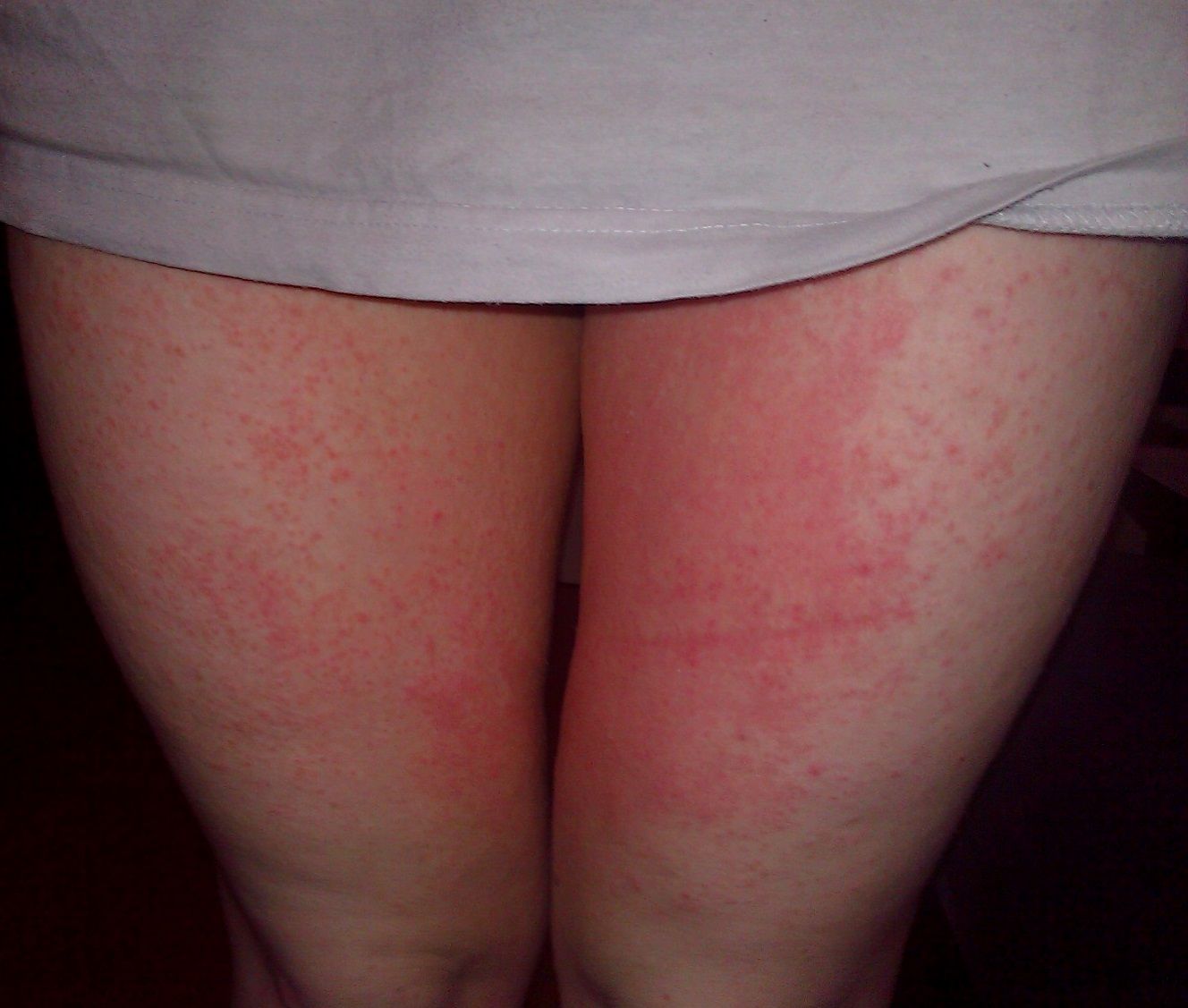 Thigh Sweat Rash - How To Prevent » Chaffree