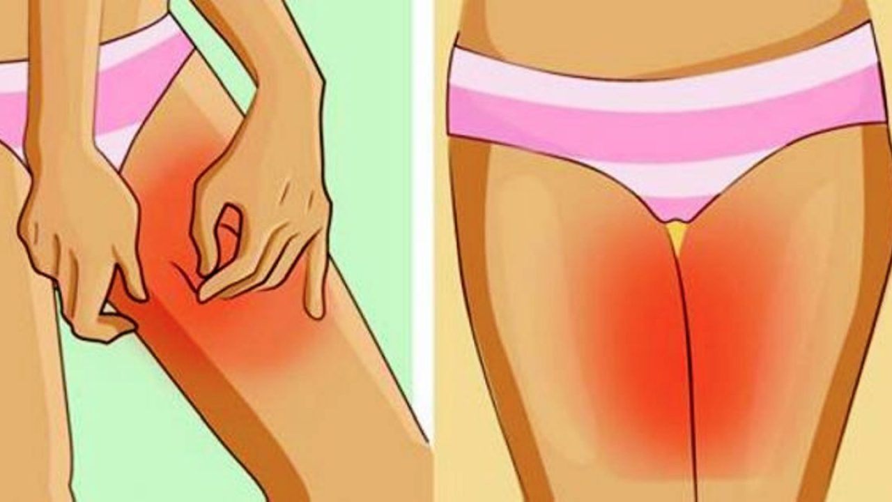 How to Treat Chafing in the Female Groin Area - No More Chafe - Thigh Guards
